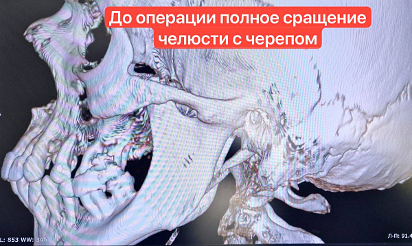 Врачи горбольницы №5 провели уникальную операцию по восстановлению челюсти