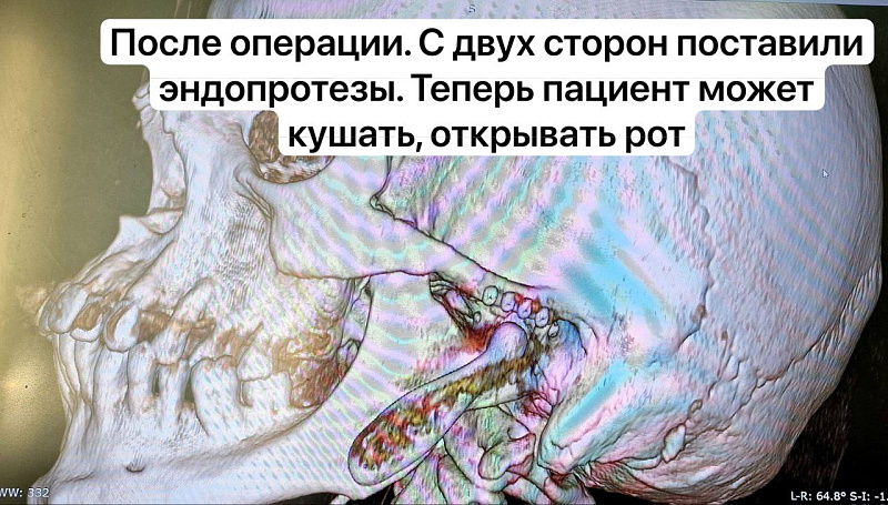 Врачи горбольницы №5 провели уникальную операцию по восстановлению челюсти